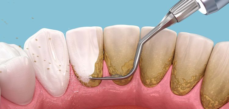 7 Cara Efektif Menghilangkan Plak Gigi Tanpa Harus ke Dokter